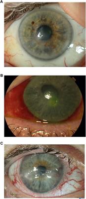 New Pharmacological Approaches for the Treatment of Neurotrophic Keratitis